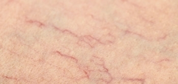 Kılcal Varis Tedavisi