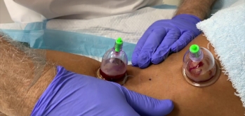 Hacamat Varise İyi Gelir mi?