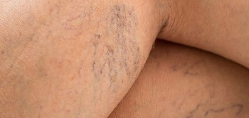 Varis Belirtileri ve Teşhisi