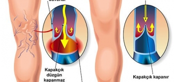 Varis Neden Oluşur?